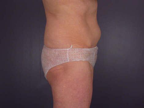 Tummy Tuck Before & After Image