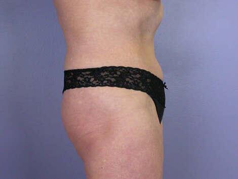 Tummy Tuck Before & After Image