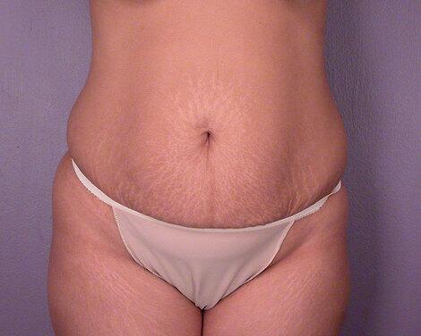 Tummy Tuck Before & After Image