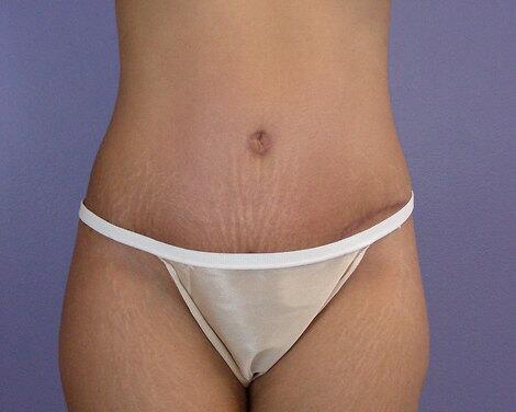 Tummy Tuck Before & After Image