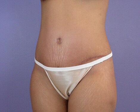 Tummy Tuck Before & After Image