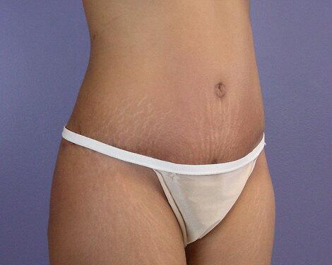 Tummy Tuck Before & After Image