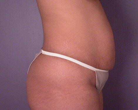 Tummy Tuck Before & After Image