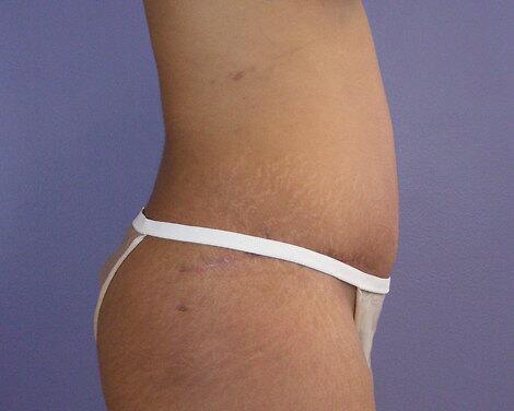 Tummy Tuck Before & After Image