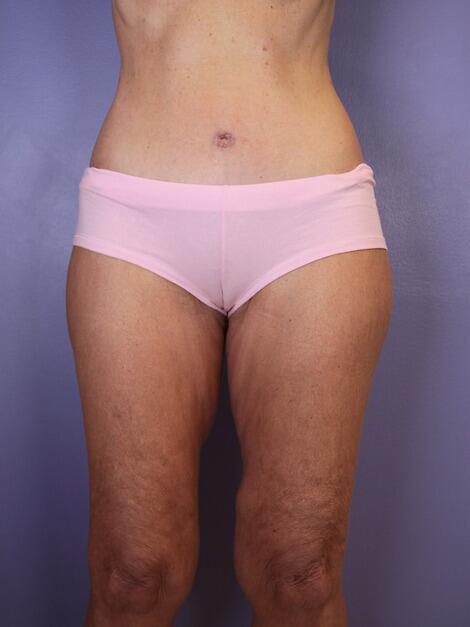 Tummy Tuck Before & After Image