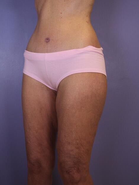 Tummy Tuck Before & After Image