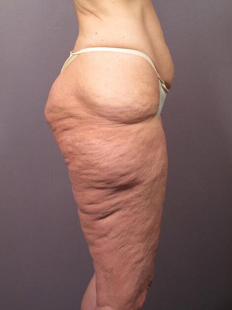 Tummy Tuck Before & After Image