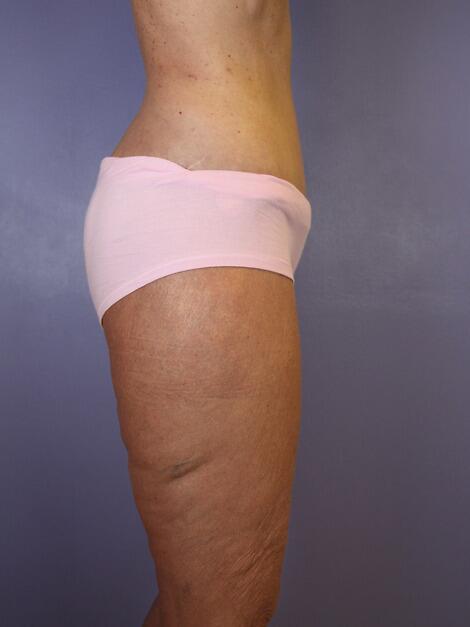 Tummy Tuck Before & After Image