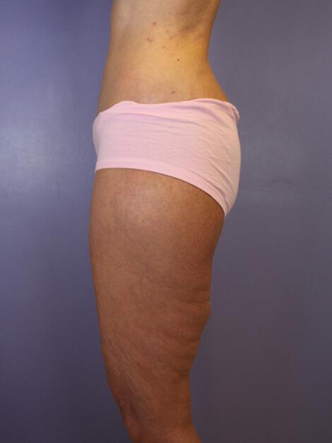 Tummy Tuck Before & After Image