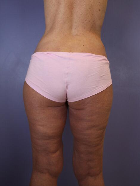 Tummy Tuck Before & After Image