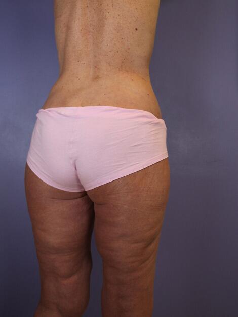 Tummy Tuck Before & After Image