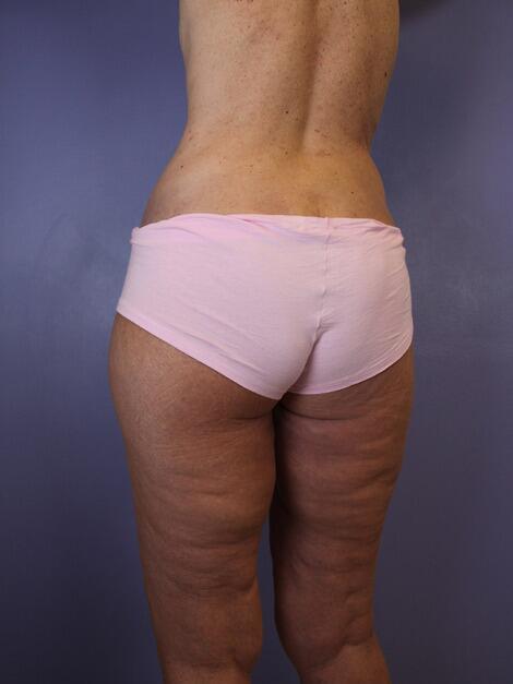 Tummy Tuck Before & After Image