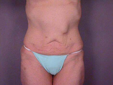 Tummy Tuck Before & After Image