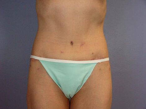 Tummy Tuck Before & After Image