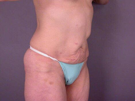 Tummy Tuck Before & After Image