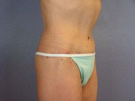 Tummy Tuck Before & After Image