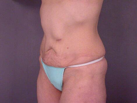 Tummy Tuck Before & After Image