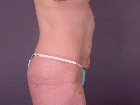 Tummy Tuck Before & After Image