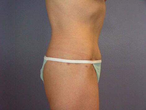 Tummy Tuck Before & After Image