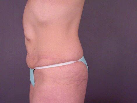 Tummy Tuck Before & After Image