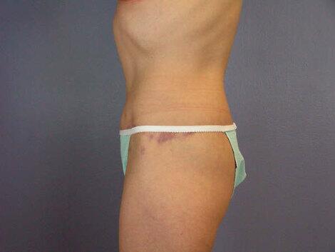 Tummy Tuck Before & After Image