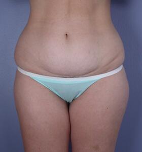 Tummy Tuck Before & After Image