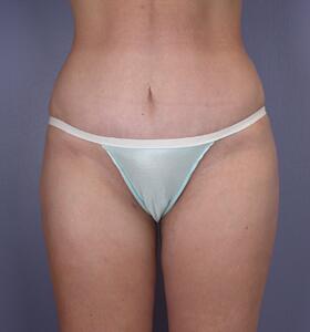 Tummy Tuck Before & After Image