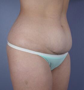 Tummy Tuck Before & After Image