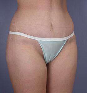 Tummy Tuck Before & After Image