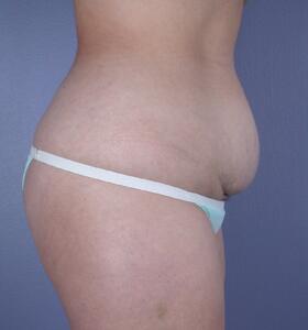 Tummy Tuck Before & After Image