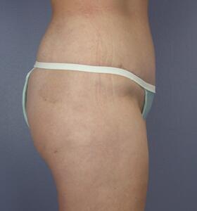 Tummy Tuck Before & After Image