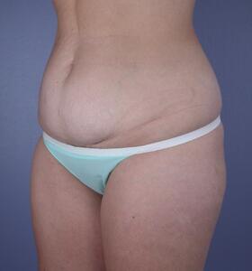 Tummy Tuck Before & After Image