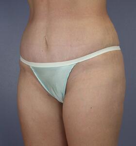 Tummy Tuck Before & After Image