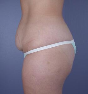 Tummy Tuck Before & After Image