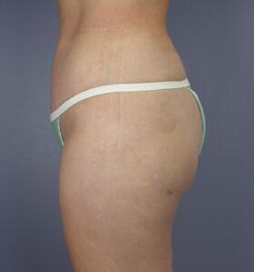 Tummy Tuck Before & After Image