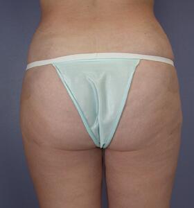 Tummy Tuck Before & After Image