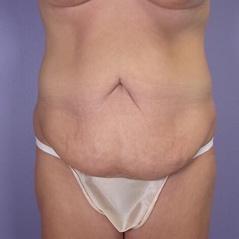 Tummy Tuck Before & After Image