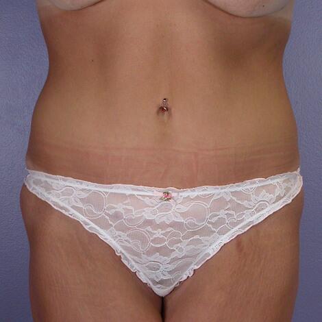 Tummy Tuck Before & After Image