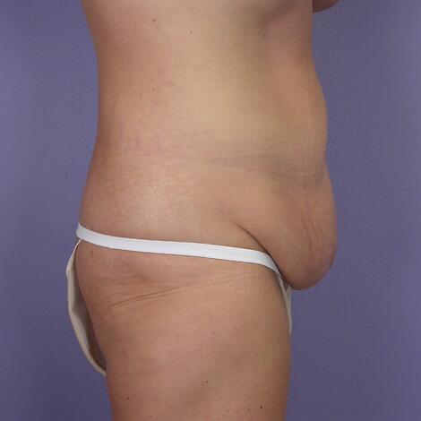 Tummy Tuck Before & After Image