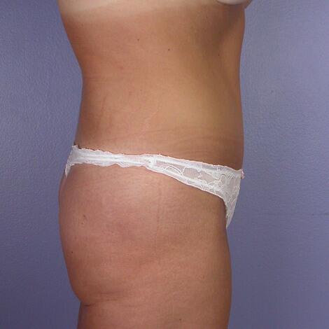 Tummy Tuck Before & After Image