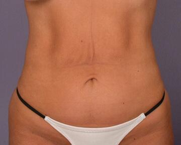 Tummy Tuck Before & After Image