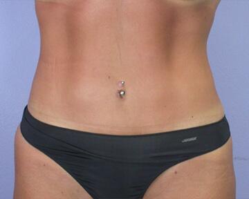 Tummy Tuck Before & After Image