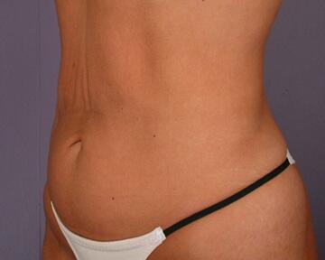 Tummy Tuck Before & After Image