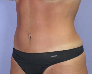 Tummy Tuck Before & After Image