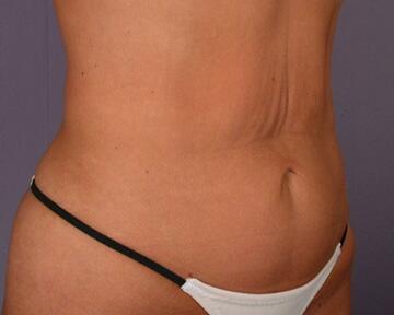 Tummy Tuck Before & After Image