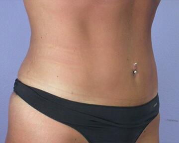 Tummy Tuck Before & After Image