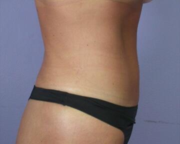 Tummy Tuck Before & After Image