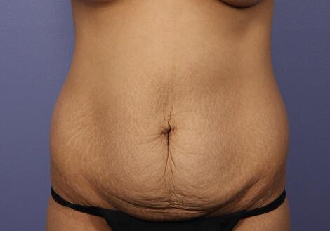 Tummy Tuck Before & After Image