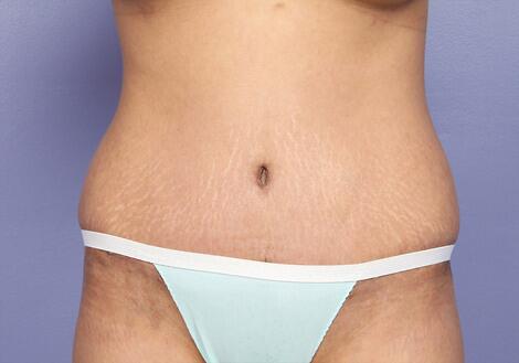 Tummy Tuck Before & After Image