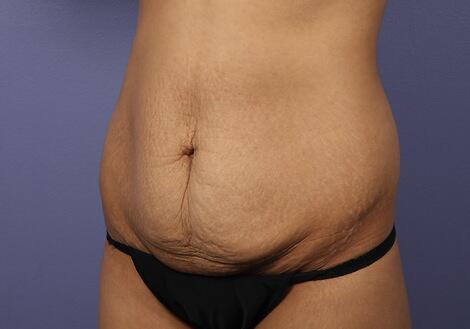 Tummy Tuck Before & After Image